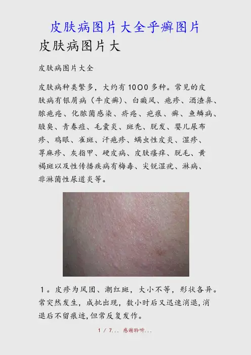 最新皮肤病图片大全乎癣图片(精品收藏)