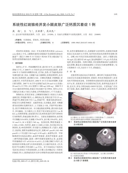 系统性红斑狼疮并发小腿皮肤广泛钙质沉着症1例
