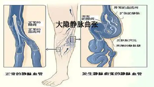 大隐静脉曲张PPT培训教程