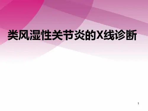类风湿性关节炎的X线诊断PPT课件