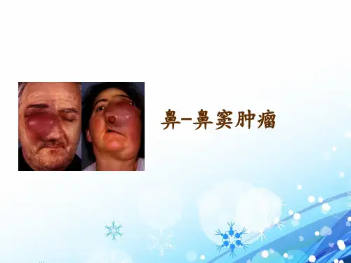 鼻部肿瘤  ppt课件
