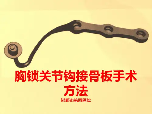 胸锁关节钩接骨板手术方式
