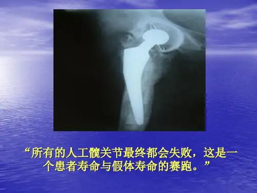 全陶关节在全髋置换术中的应用