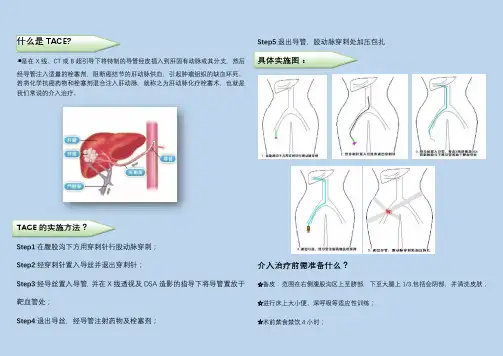 肝动脉化疗栓塞(TACE)的围手术期详解