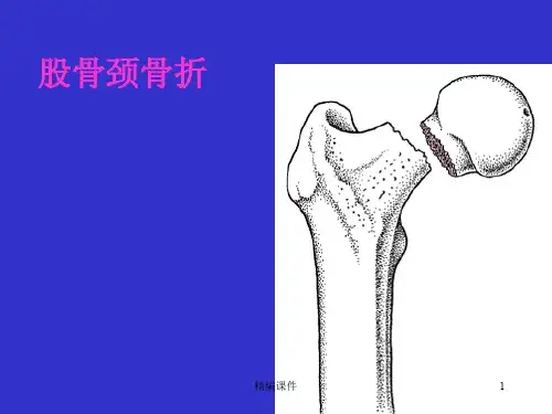 股骨颈骨折【培训学习】