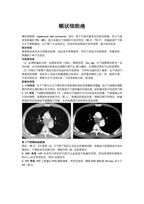 鳞状细胞癌