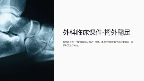 “外科临床课件-拇外翻足”