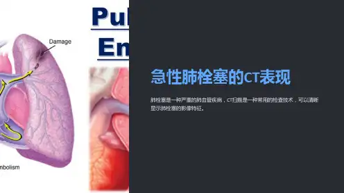 急性肺栓塞的CT表现