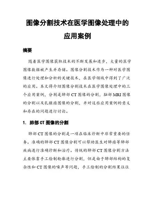 图像分割技术在医学图像处理中的应用案例