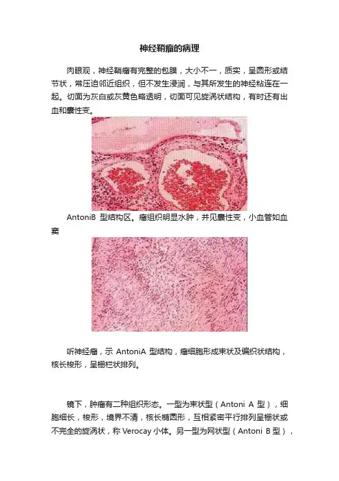 神经鞘瘤的病理
