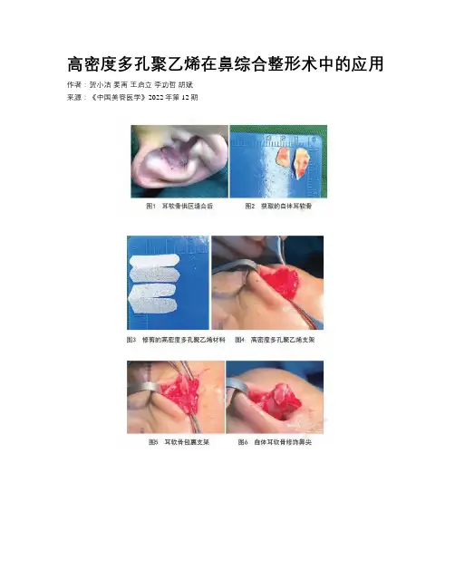 高密度多孔聚乙烯在鼻综合整形术中的应用