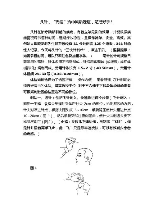 头针，“光速”治中风后遗症，是把好手！