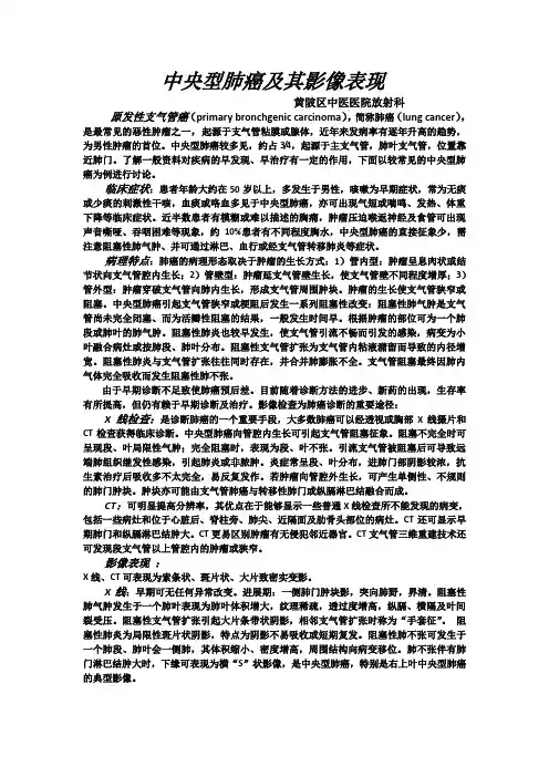 中央型肺癌