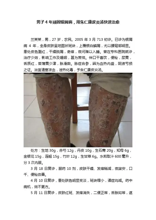 男子4年顽固银屑病，用朱仁康皮炎汤快速治愈