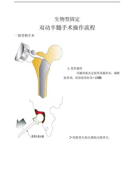 髋关节置换手术操作流程