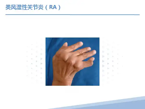 内科学课件类风湿性关节炎
