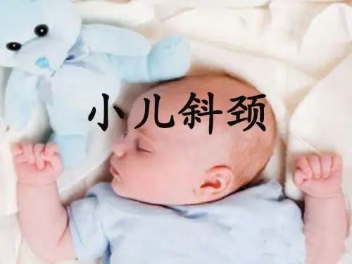 小儿斜颈