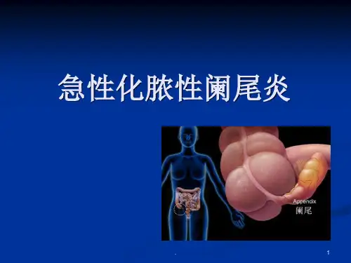 急性化脓性阑尾炎PPT课件