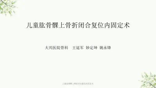 儿童肱骨髁上骨折闭合复位内固定术课件