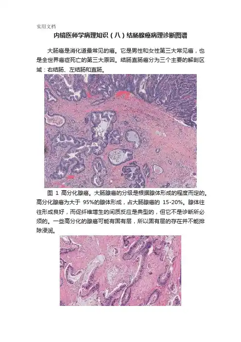 内镜医师学病理知识(八)结肠腺癌病理诊断图谱