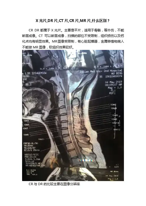 X光片,DR片,CT片,CR片,MR片,什么区别？