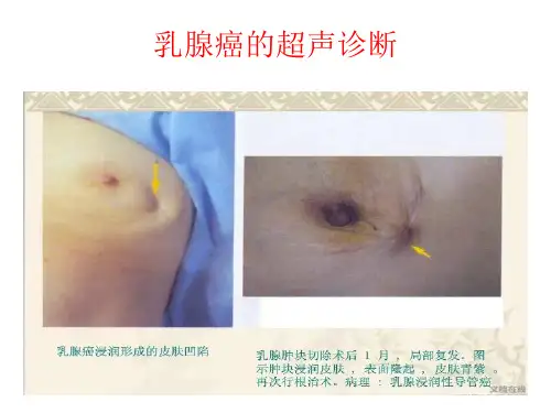 乳腺癌的超声诊断课件