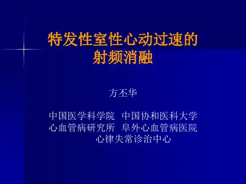 特发性室性心动过速的射频消融