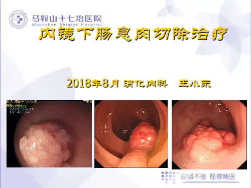 内镜下肠息肉治疗 