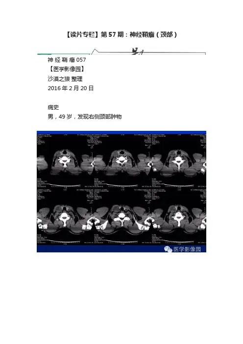 【读片专栏】第57期：神经鞘瘤（颈部）