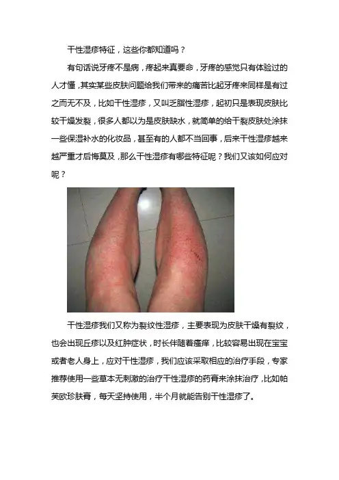 干性湿疹特征？这些你都知道吗？