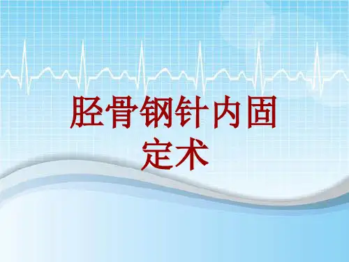 外科手术教学资料：胫骨钢针内固定术讲解模板