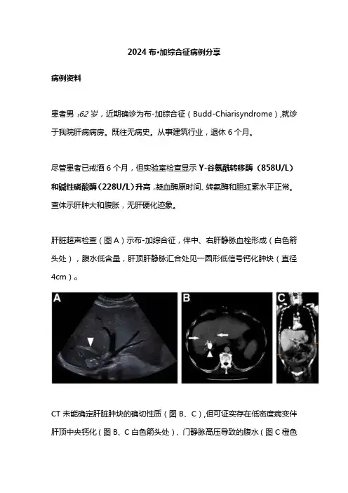 2024布加综合征病例分享
