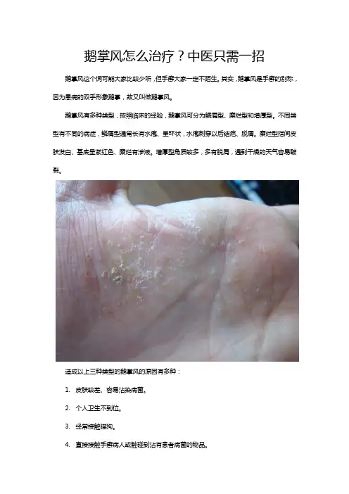 鹅掌风怎么治？中医只需一招