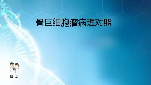 骨巨细胞瘤ppt课件