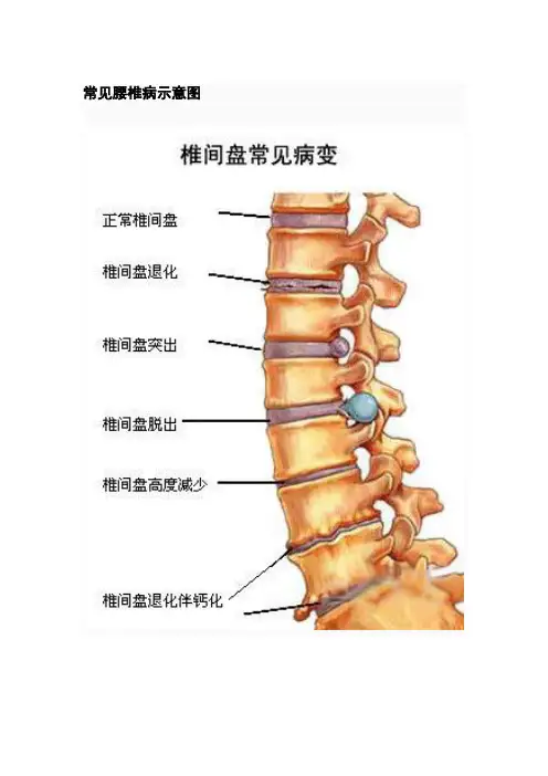 腰椎病常见锻炼方法