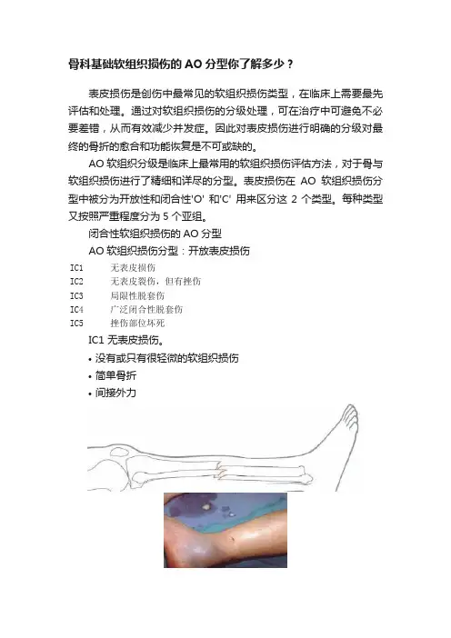 骨科基础软组织损伤的AO分型你了解多少？