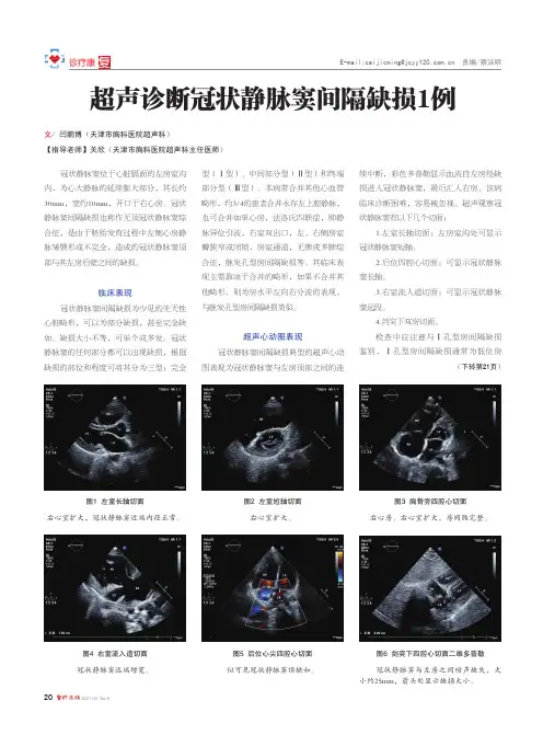 超声诊断冠状静脉窦间隔缺损1例