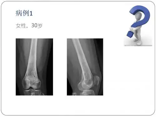 非骨化性纤维瘤的x线诊断及鉴别诊断ppt课件