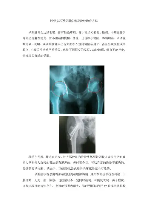 股骨头坏死早期症状及最佳治疗方法