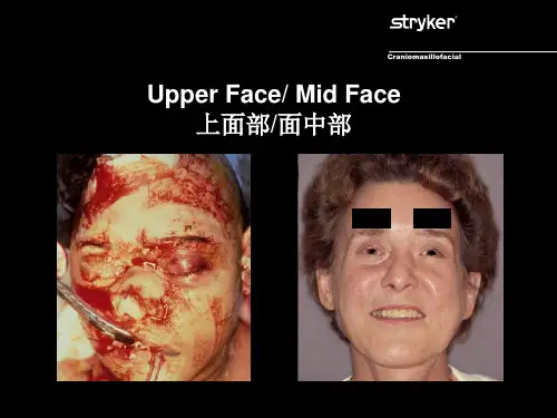 上颌面中颌面骨折解剖形态综述uppermidface课件