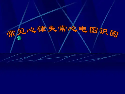 常见心律失常心电图识图