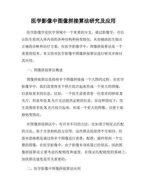医学影像中图像拼接算法研究及应用