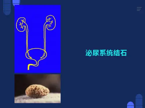 肾结石诊疗指南