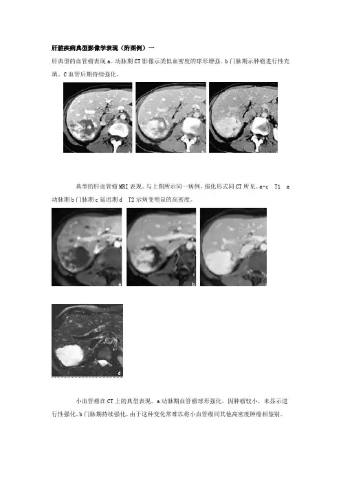 肝脏疾病典型影像学表现(附图例)