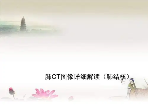 肺CT图像详细解读(肺结核)