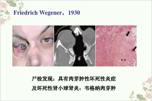 系统性血管炎PPT.