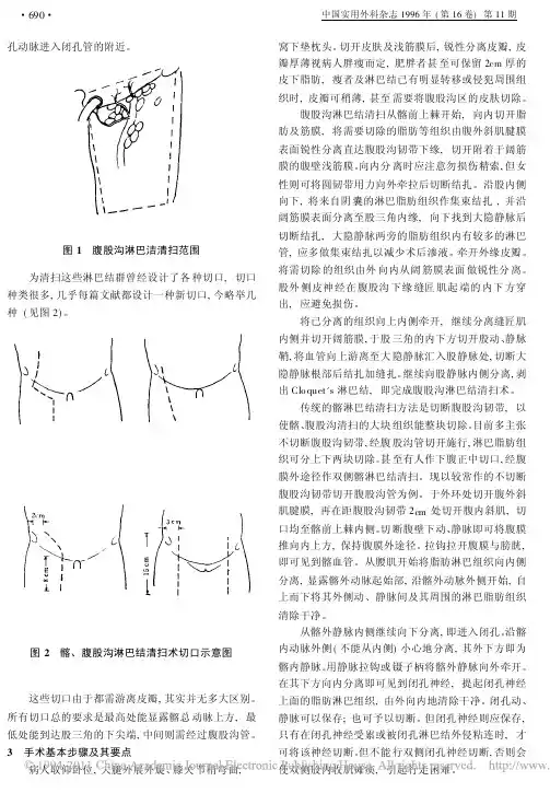 髂_腹股沟淋巴结清扫术