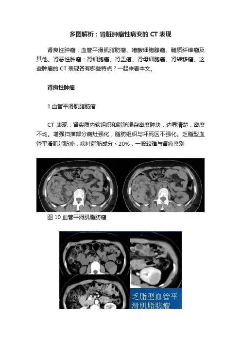多图解析：肾脏肿瘤性病变的CT表现