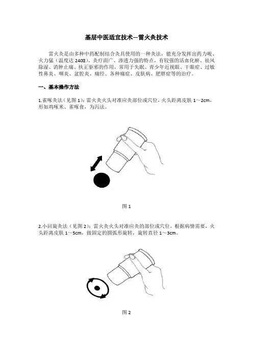 基层中医适宜技术之雷火灸