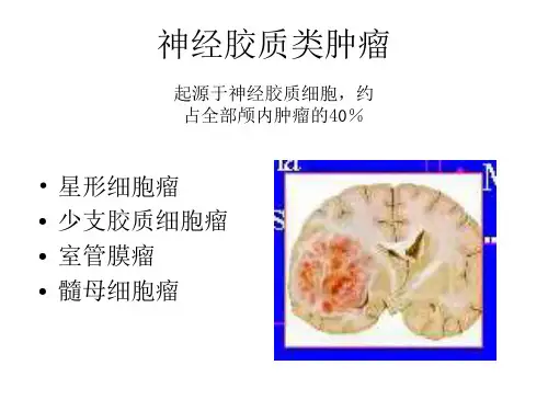 星形细胞瘤CT诊断